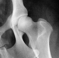 Normal X-ray of Hip